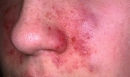 Yağlı Egzama Belirtileri ve Tedavisi