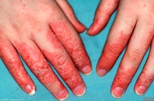 Egzama Nedir? Egzama Hastalığı Nedir?