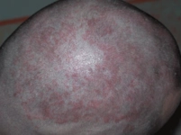 Kafada Egzama Belirtileri ve Tedavisi